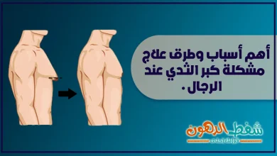 كبر الثدي عند الرجال